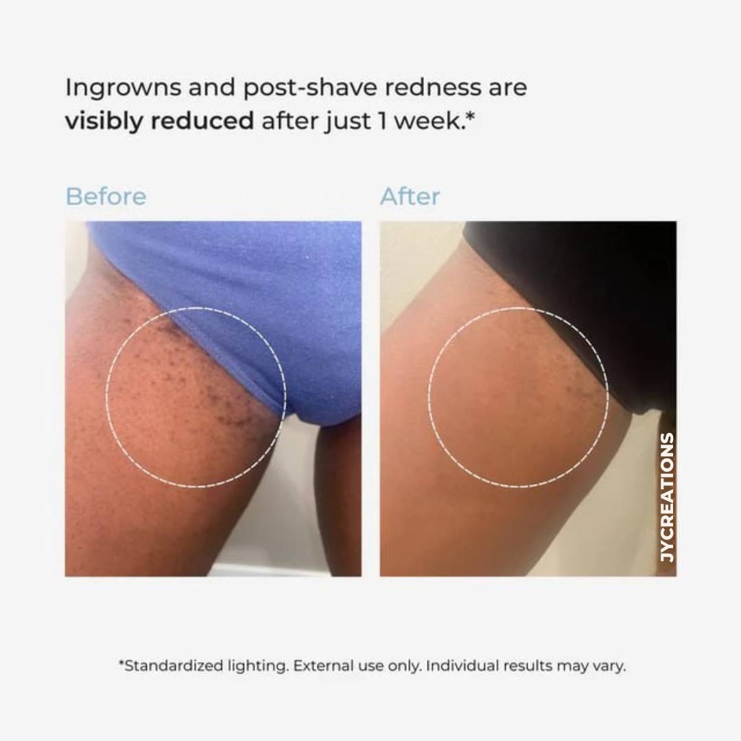 Smoothing Solution Ingrown Hair Treatment